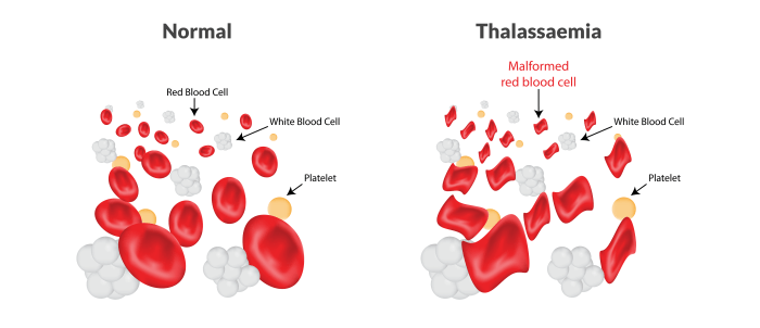 Thalasemia Minor Fakta, Diagnosis, Pengobatan, dan Dampak Sosial