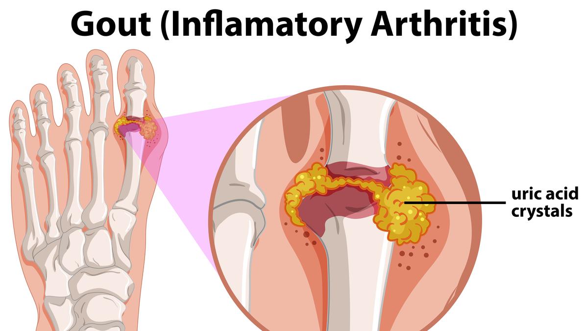 Mengenal Tofi pada Penderita Asam Urat Gejala dan Cara Penanganannya